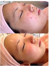 ウェリナベル(WelinaBelle)/無添加国産ハーブピーリング