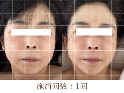 アンスリウム(ansrium)の写真