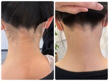 パール(PEARL)/八尾脱毛サロン・うなじ脱毛