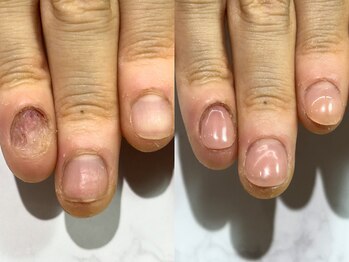 アリエ(allie)/10年近く爪が生えてこなかった