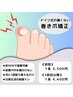 【巻き爪矯正】日常生活の制限ナシ♪月1回でOK！　  2回目以降　¥4,400