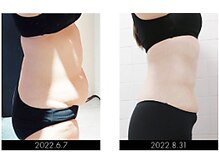 ラグラン銀座メディカルエステ 高輪ゲートウェイ店/【BODY】セルマジ・ビフォアフ