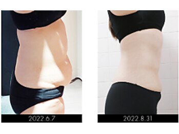 ラグラン銀座メディカルエステ 高輪ゲートウェイ店/【BODY】セルマジ・ビフォアフ