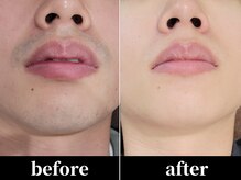 ユアースタイル 四日市店(YOUR Style)/【メンズ脱毛】ヒゲ脱毛 #脱毛