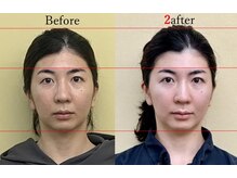 アプロ(APLO)/自律神経調整＋小顔矯正