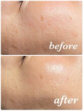 イーストモア(EAST MOIS)/W光フェイシャルで小じわ改善