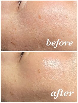 イーストモア(EAST MOIS)/W光フェイシャルで小じわ改善