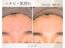 スリースリー(THREE THREE)/ニキビ・肌荒れケア