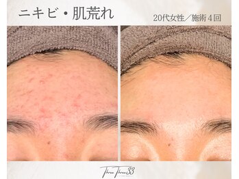 スリースリー(THREE THREE)/ニキビ・肌荒れケア