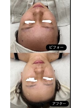 メリアミーゴ(Meli amigo)/20代 ハーブピーリング