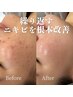【ニキビ卒業】繰り返すニキビを根本改善!ラエッセハーブ×深部導入コース