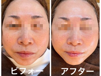 ナオフクオカ ヒーリングフォースエヌ(NaoFukuoka/healingforceN)/最強美容機器で弛みも毛穴も。
