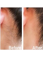 チョコレート(chocolate)/うなじワックス脱毛