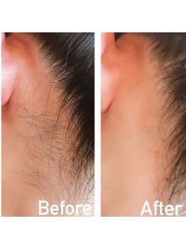 チョコレート(chocolate)/うなじワックス脱毛