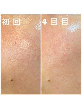 ガーデン(Garden)/ハーブピーリング4