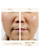 ダイヤ 名古屋中川区店(Daiya)/■ララピール/美肌根本ケア