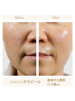 ダイヤ 名古屋中川区店(Daiya)/■ララピール/美肌根本ケア