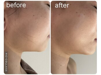 ジュエル(Jewel)/マグマハーブ一回の小顔効果