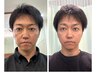 【むくみ・リフトアップ・肌悩みに◎】初めてでも安心♪　メンズ美容鍼