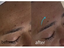 ルーム701(room701)/おでこ　額　しわ　深いしわ