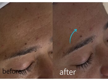 ルーム701(room701)/おでこ 額 しわ 深いしわ