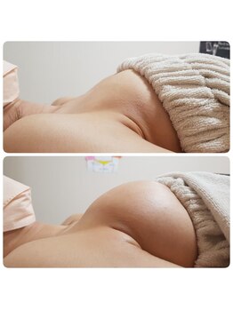 美人バスト リグラス(ReGrous)/バストアップbefore,after