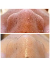 プランス 熊本(PLANCE)/毛穴ケアお任せください！