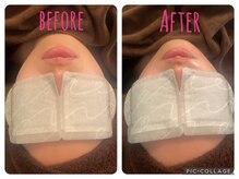 セリーヌ(serene)/小顔ラジオ波