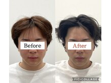 鍼灸チャンドラ(鍼灸Chandra)/女優鍼