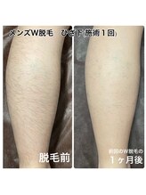ネイキッドベージュ 恵比寿店(Naked Beige)/メンズW脱毛★ビフォーアフター