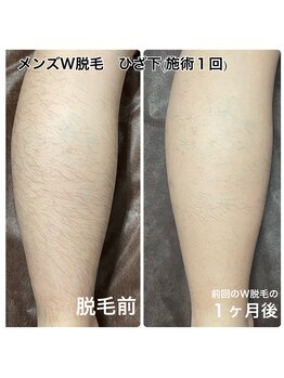 ネイキッドベージュ 恵比寿店(Naked Beige)/メンズW脱毛★ビフォーアフター