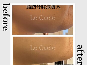 ルカシエ(Le Cacie)/30代女性/二重顎脂肪分解液導入