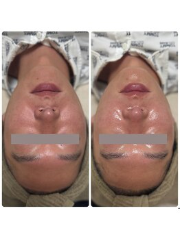 サラン(SALON)/メンズ ビフォーアフター