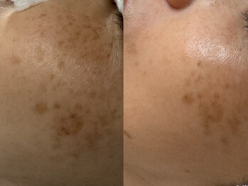 サラグランデ(Sara Grande)/シミケア7回施術