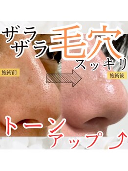 ハロップ 銀座本店(HARROP)/水素水毛穴洗浄でトーンアップ!