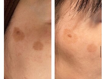 カルミア(kalmia)/【シミケア】レチノールピール