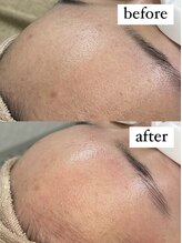 テンパ ビューティー(+10%beauty)/一撃タマゴ肌ワックス