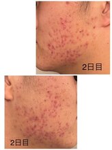 ケーフリー(K-free)/ハーブピーリング