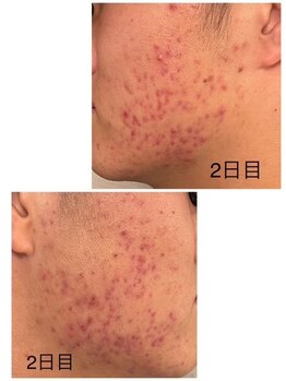 ケーフリー(K-free)/ハーブピーリング