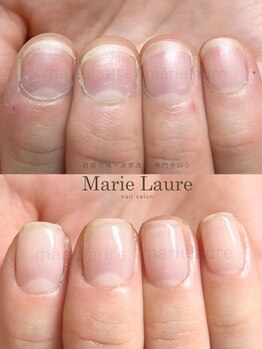 マリーロール 梅田店(Marie Laure)/深爪矯正/自爪育成/自爪風