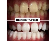 ホワイトニングサロン 豊中/Before&After美白ホワイトニング