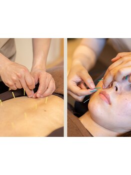 鍼灸施術を受けたい