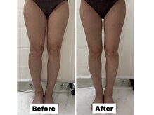 カノア(KANOA)/脂肪冷却