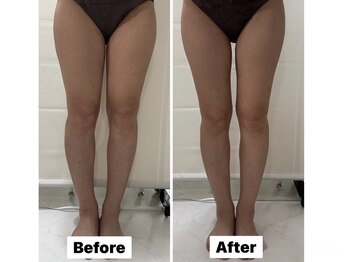 カノア(KANOA)/脂肪冷却