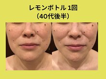 リンク 錦糸町店(Link)/レモンボトル1回