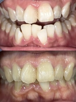 アルクローゼット(aru closet)/ホワイトニングビフォーアフター