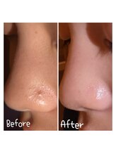 サロンドビオ(Salon de vio)/毛穴洗浄