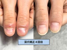 アリエ(allie)/まるで自爪/バレない深爪矯正