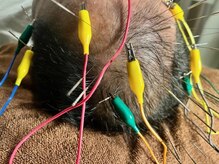 ヘッドサイエンス(HEADSCIENCE)/鍼に電気を流し育毛促進ブースト