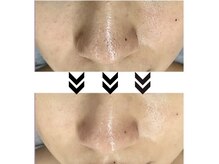 ハピエスト 御坊店/毛穴洗浄